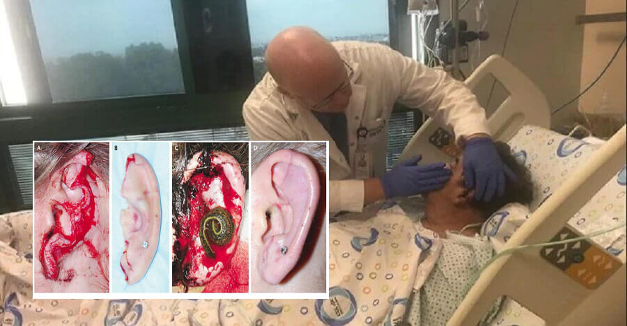 پزشکان طب سنتی با زالو، گوش قطع شده را در اسرائیل نجات دادند